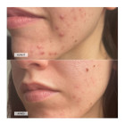 Светодиодная маска CurrentBody Skin Anti-Blemish LED Face Mask против несовершенств кожи