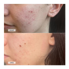 Светодиодная маска CurrentBody Skin Anti-Blemish LED Face Mask против несовершенств кожи