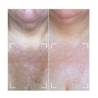 Набор CurrentBody Skin LED Light Therapy Face & Neck Kit: Series 2 для лица, шеи и зоны декольте