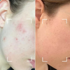 Светодиодная маска CurrentBody Skin Anti-Imperfections LED Face Mask: Series 2 против несовершенств кожи