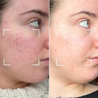 Светодиодная маска CurrentBody Skin Anti-Imperfections LED Face Mask: Series 2 против несовершенств кожи