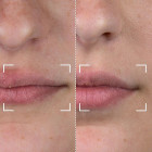 Светодиодный прибор для губ CurrentBody Skin LED Lip Perfector 