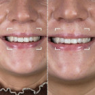Набор для отбеливания зубов CurrentBody Skin LED Teeth Whitening Kit