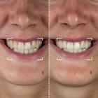 Набор для отбеливания зубов CurrentBody Skin LED Teeth Whitening Kit
