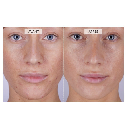 Светодиодная маска CurrentBody Skin Anti-Blemish LED Face Mask против несовершенств кожи