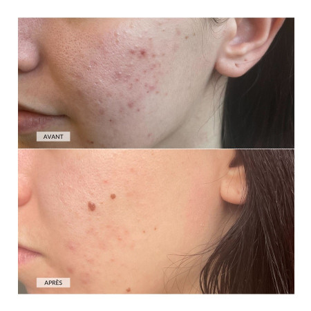 Светодиодная маска CurrentBody Skin Anti-Blemish LED Face Mask против несовершенств кожи