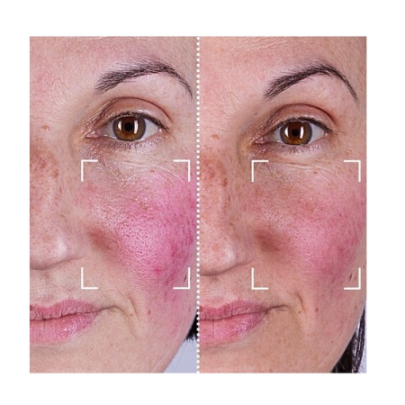 Набор CurrentBody Skin LED Light Therapy Face & Neck Kit: Series 2 для лица, шеи и зоны декольте