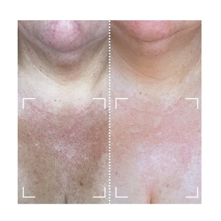 Набор CurrentBody Skin LED Light Therapy Face & Neck Kit: Series 2 для лица, шеи и зоны декольте