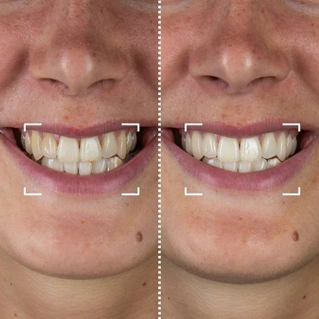Набір для відбілювання зубів CurrentBody Skin LED Teeth Whitening Kit